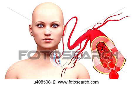 Human arteries, artwork View Large Illustration Drawing - Human arteries, artwork. Fotosearch