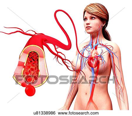 Stock Illustration - Human artery, artwork. Fotosearch