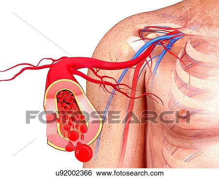 Stock Illustration - Human artery, artwork. Fotosearch