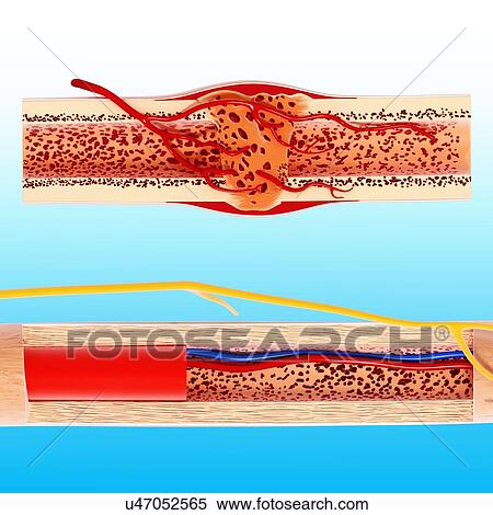 Stock Illustration - Human bone structure, artwork. Fotosearch