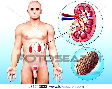 Human kidney stones, artwork View Large Illustration Drawing - Human kidney stones, artwork. Fotosearch