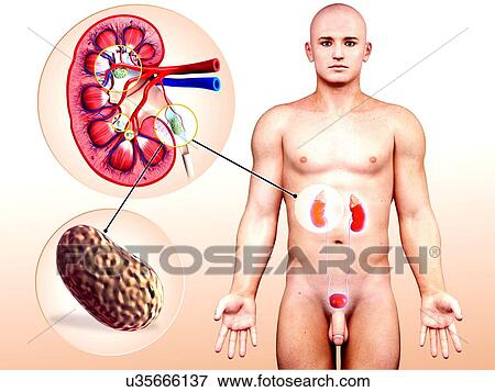 Human kidney stones, artwork View Large Illustration Stock Illustration - Human kidney stones, artwork. Fotosearch