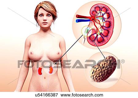 Human kidney stones, artwork View Large Illustration Stock Illustration - Human kidney stones, artwork. Fotosearch