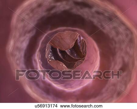 Stock Illustration - Inflamed colon, artwork. Fotosearch