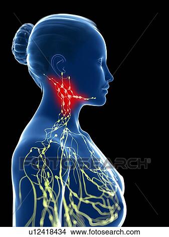 Stock Illustration - Inflamed lymph nodes, artwork. Fotosearch