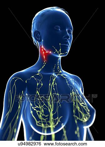 Inflamed lymph nodes, artwork View Large Illustration Stock Illustration - Inflamed lymph nodes, artwork. Fotosearch