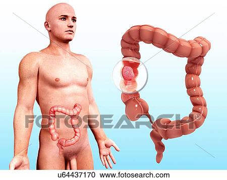 Intestinal cancer, artwork View Large Illustration Clipart - Intestinal cancer, artwork. Fotosearch