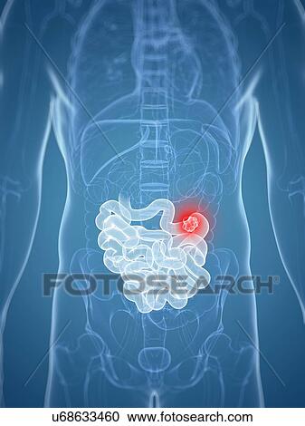 Intestinal cancer, artwork View Large Illustration Clipart - Intestinal cancer, artwork. Fotosearch