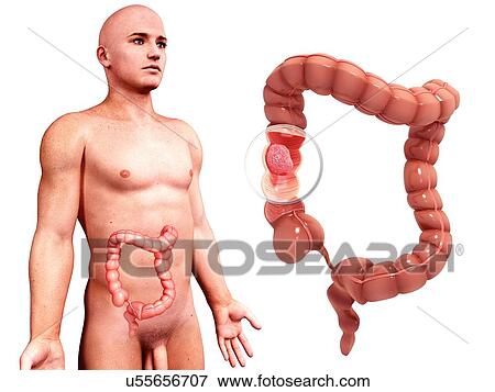 Intestinal cancer, artwork View Large Illustration Stock Illustration - Intestinal cancer, artwork. Fotosearch
