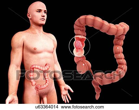 Stock Illustration - Intestinal cancer, artwork. Fotosearch