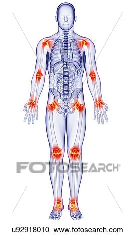Clipart - Joint pain, artwork. Fotosearch