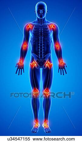 Stock Illustration - Joint pain, artwork. Fotosearch