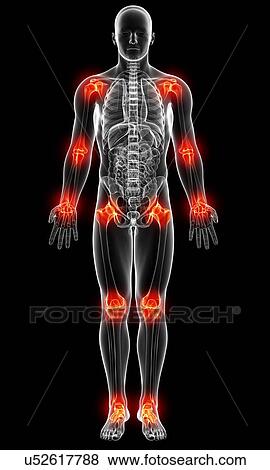 Stock Illustration - Joint pain, artwork. Fotosearch