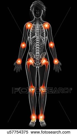 Joint pain, artwork View Large Illustration Stock Illustration - Joint pain, artwork. Fotosearch