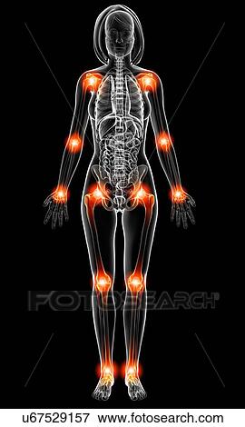 Stock Illustration - Joint pain, artwork. Fotosearch