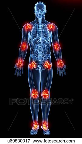 Joint pain, artwork View Large Illustration Stock Illustration - Joint pain, artwork. Fotosearch