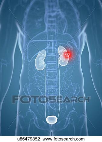 Drawing - Kidney cancer, artwork. Fotosearch