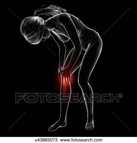 Drawing - Knee pain, artwork. Fotosearch