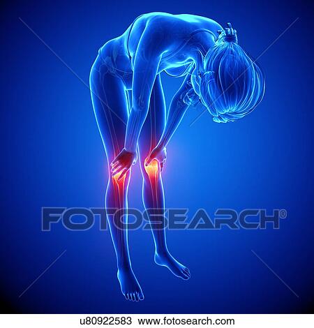 Drawing - Knee pain, artwork. Fotosearch