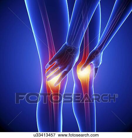 Knee pain, artwork View Large Illustration Stock Illustration - Knee pain, artwork. Fotosearch