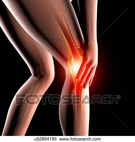 Stock Illustration - Knee pain, artwork. Fotosearch