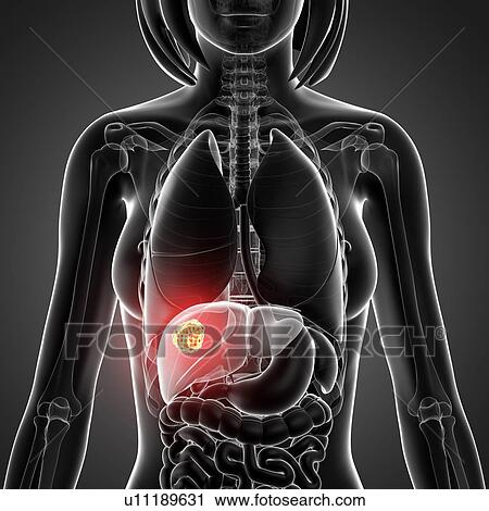 Clip Art - Liver cancer, artwork. Fotosearch