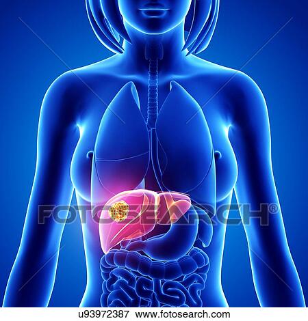 Stock Illustration - Liver cancer, artwork. Fotosearch