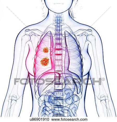 Lung cancer, artwork View Large Illustration Clipart - Lung cancer, artwork. Fotosearch