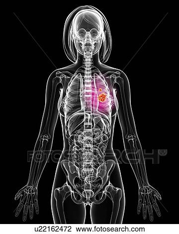 Lung cancer, artwork View Large Illustration Drawing - Lung cancer, artwork. Fotosearch