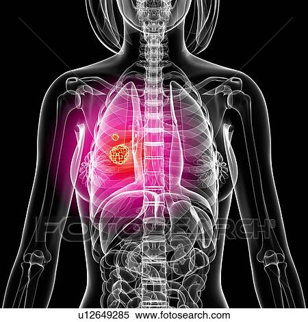 Stock Illustration - Lung cancer, artwork. Fotosearch