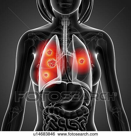 Lung cancer, artwork View Large Illustration Stock Illustration - Lung cancer, artwork. Fotosearch
