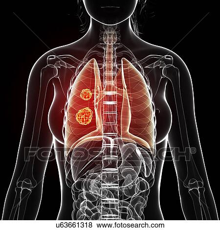 Stock Illustration - Lung cancer, artwork. Fotosearch