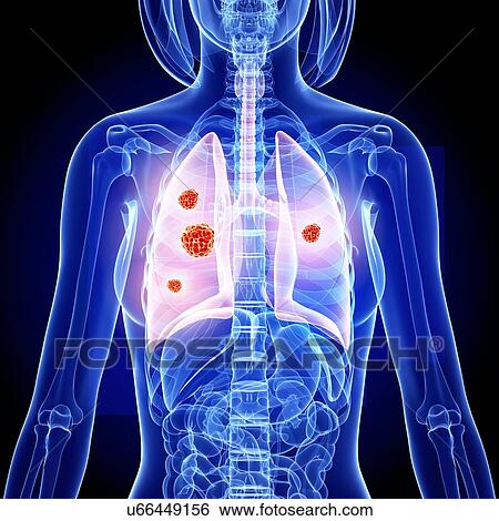 Lung cancer, artwork View Large Illustration Stock Illustration - Lung cancer, artwork. Fotosearch
