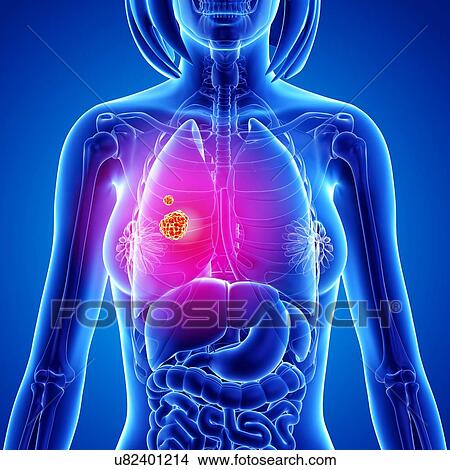Stock Illustration - Lung cancer, artwork. Fotosearch