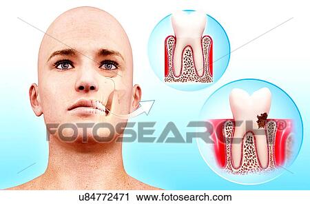 Clip Art - Molar tooth, artwork. Fotosearch