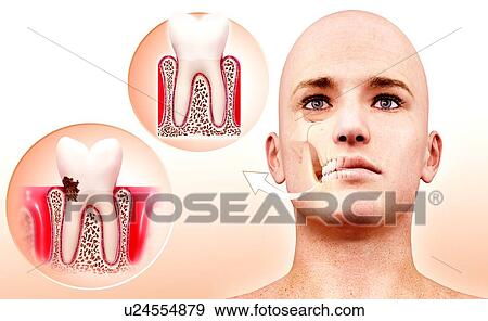 Stock Illustration - Molar tooth, artwork. Fotosearch