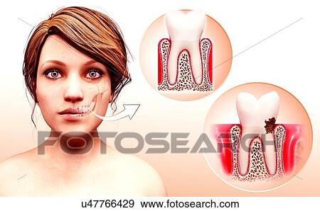 Stock Illustration - Molar tooth, artwork. Fotosearch