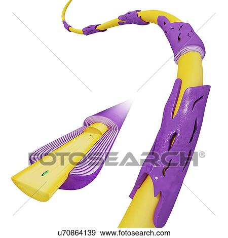 Stock Illustration - Myelin deterioration, artwork. Fotosearch