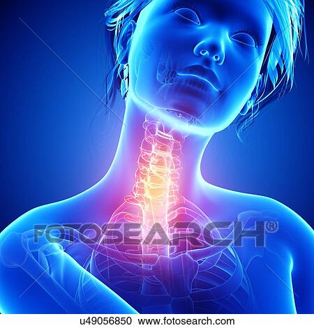 Clipart - Neck pain, artwork. Fotosearch