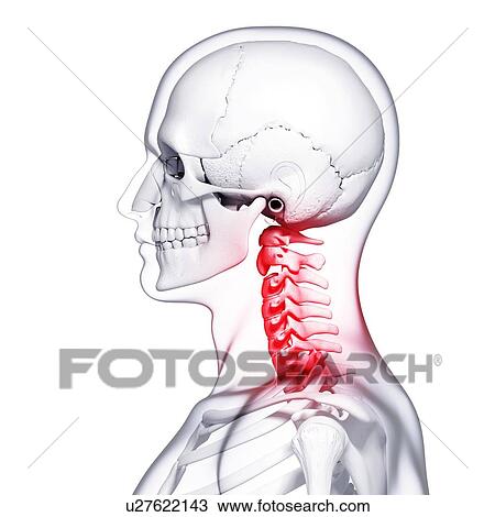 Drawing - Neck pain, artwork. Fotosearch