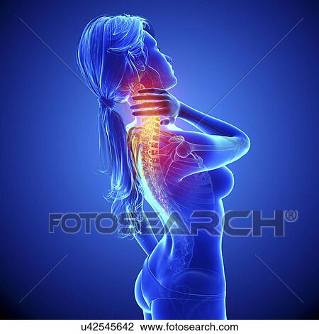 Neck pain, artwork View Large Illustration Drawing - Neck pain, artwork. Fotosearch