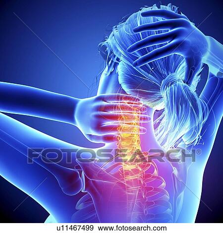 Neck pain, artwork View Large Illustration Stock Illustration - Neck pain, artwork. Fotosearch
