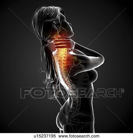 Stock Illustration - Neck pain, artwork. Fotosearch