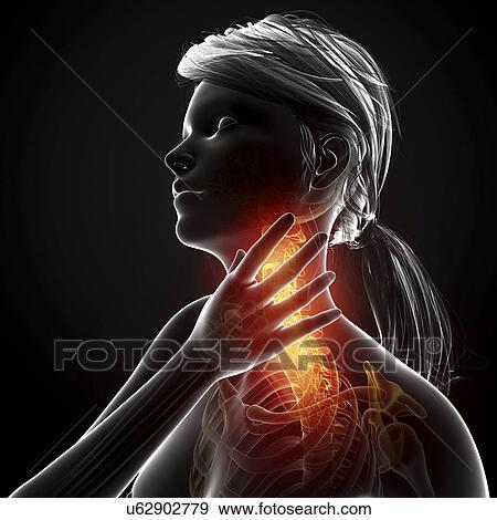 Stock Illustration - Neck pain, artwork. Fotosearch