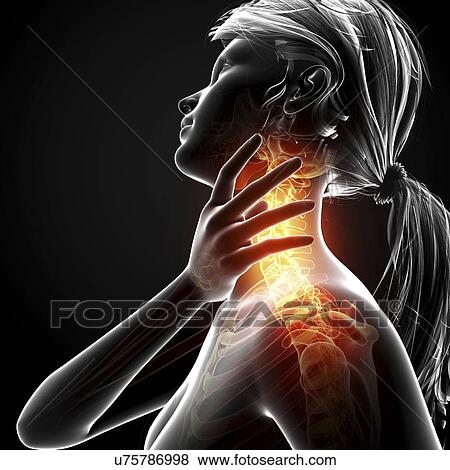 Stock Illustration - Neck pain, artwork. Fotosearch