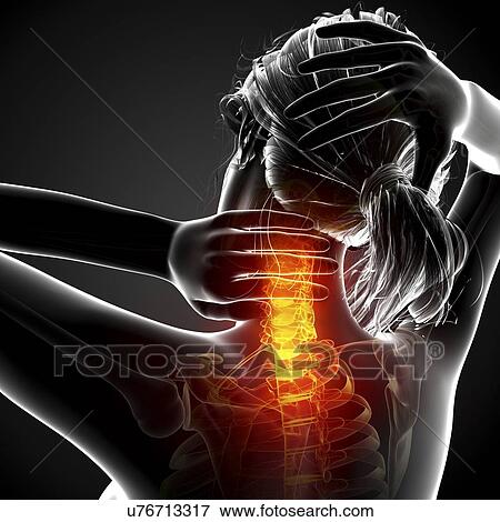 Stock Illustration - Neck pain, artwork. Fotosearch