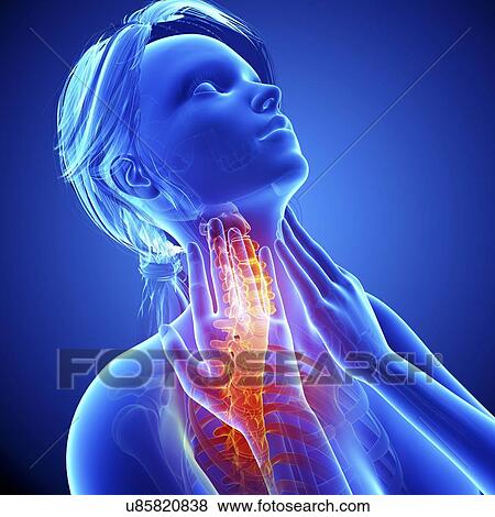 Neck pain, artwork View Large Illustration Stock Illustration - Neck pain, artwork. Fotosearch