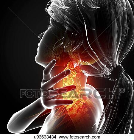 Stock Illustration - Neck pain, artwork. Fotosearch