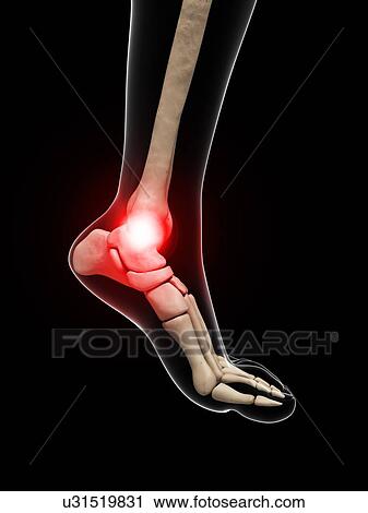 Clip Art - Painful ankle, artwork. Fotosearch