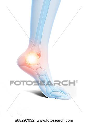 Drawing - Painful ankle, artwork. Fotosearch